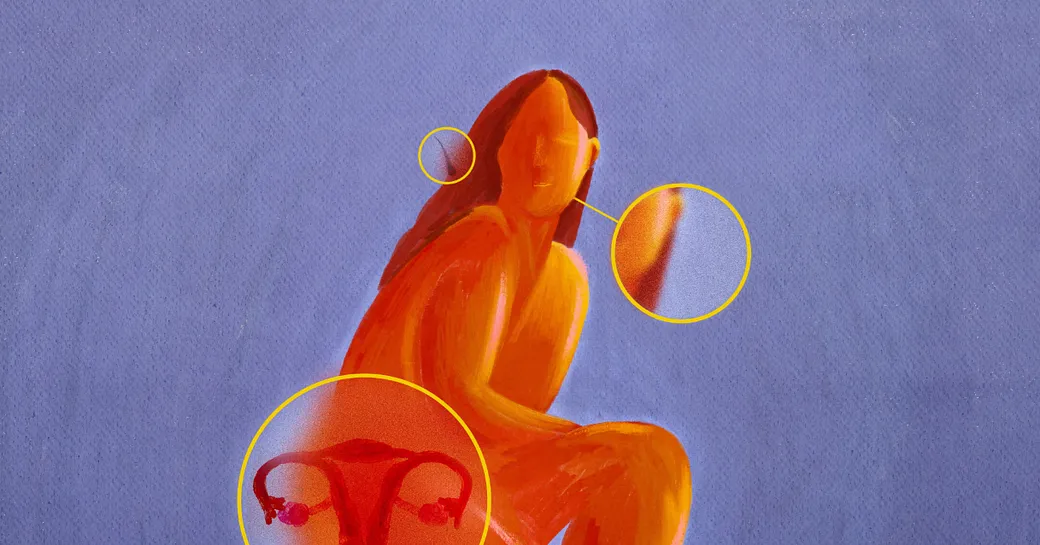 PCOS Has a New Name: Meet PMOS